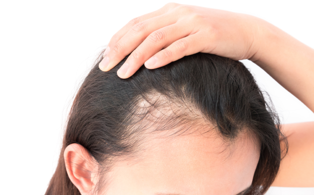 Hair Loss